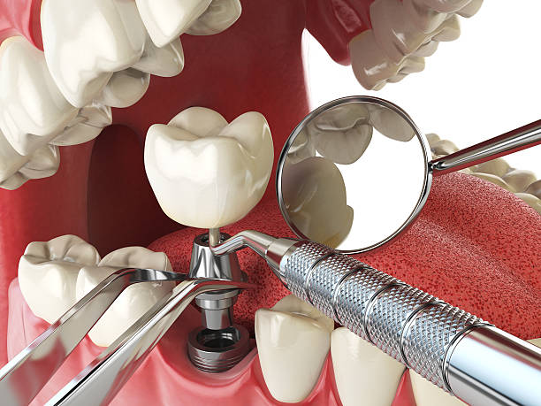 Best Emergency Root Canal Treatment in Watkinsville, GA